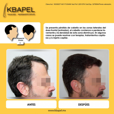 Slider image (4) Kbapel Hair Transplant